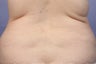 CoolSculpting to Bra Rolls/Back Fat