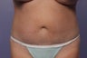 CoolSculpting to Abdomen