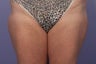 CoolSculpting Outer Thighs/Saddlebags