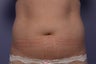 CoolSculpting to Abdomen