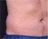 NonInvasive Fat Removal with CoolSculpting -Invented by Dr. Dieter Manstein