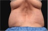 NonInvasive Fat Removal with CoolSculpting -Invented by Dr. Dieter Manstein