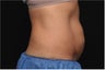 NonInvasive Fat Removal with CoolSculpting - Invented by Dr. Dieter Manstein