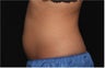 NonInvasive Fat Removal with CoolSculpting - Invented by Dr. Dieter Manstein