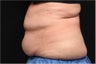 NonInvasive Fat Removal with CoolSculpting - Invented by Dr. Dieter Manstein