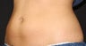 Coolsculpting-lower abdomen