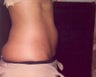 Coolsculpting Treatment