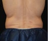 CoolSculpting on love handle and flank areas