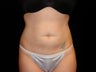 Cool Sculpting on Upper and Lower Abdomen