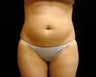 Cool Sculpting on Mid Abdomen