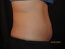 Coolsculpting