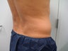 CoolSculpting