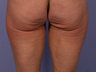 CoolSculpting to Banana Roll, Upper Posterior Thighs