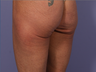 CoolSculpting to Banana Roll/ Upper, Posterior thigh