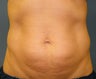 CoolSculpting