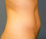 CoolSculpting