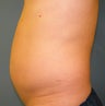 CoolSculpting