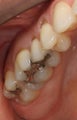 Replacing Old Silver Fillings With Porcelain Fillings