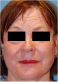 CO2 Laser Resurfacing ~ Active & Deep FX