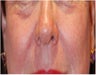 CO2 Laser Resurfacing ~ Active & Deep FX