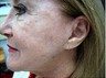 Fractional C02 laser