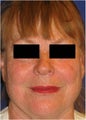 CO2 Laser Resurfacing ~ Active & Deep FX