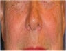 CO2 Laser Resurfacing ~ Active & Deep FX