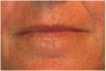 Active & Deep FX ~ CO2 Laser Skin Resurfacing