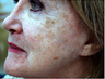 Fractional C02 laser