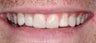 Bonding to restore the original shape of teeth
