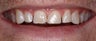 Bonding to restore the original shape of teeth