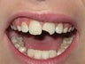 Dental Bonding #9