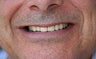 Full Porcelain Crowns (no metal)