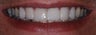 Veneers and Crowns