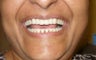 Cosmetic Dentistry Fixed Prosthesis