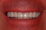 Smile Makeover With Empress All Ceramic Crowns