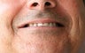 Full Porcelain Crowns (no metal)