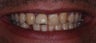 Veneers and Crowns