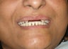 Cosmetic Dentistry Fixed Prosthesis