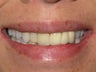 Porcelain Crowns