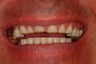 Smile Makeover With Empress All Ceramic Crowns