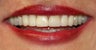 Full mouth reconstruction using implants veneers and porcelain crowns