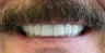 Full mouth rehabilitation using 20 implants to restore 28 teeth