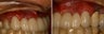 Dental implants before and after