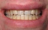 Dental Implants to Replace Missing Teeth