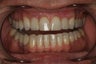 Aesthetic Implants Replace Missing Front Teeth