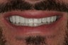 Smile Makeover: Veneers and a Bridge
