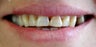 Full mouth reconstruction using implants veneers and porcelain crowns