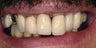 Full mouth rehabilitation using 20 implants to restore 28 teeth