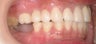 Implant
